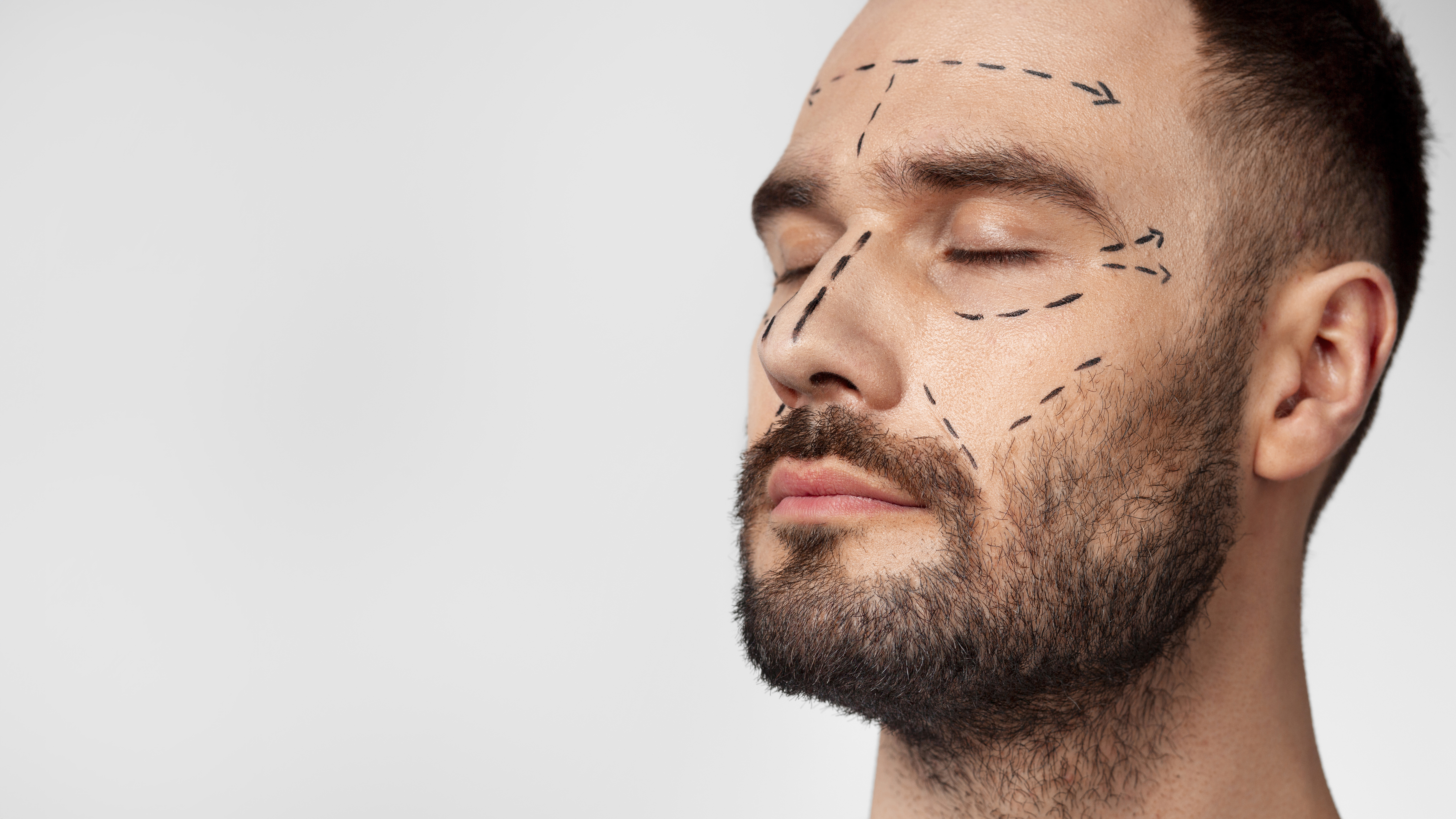 Beard & Mustache Transplant